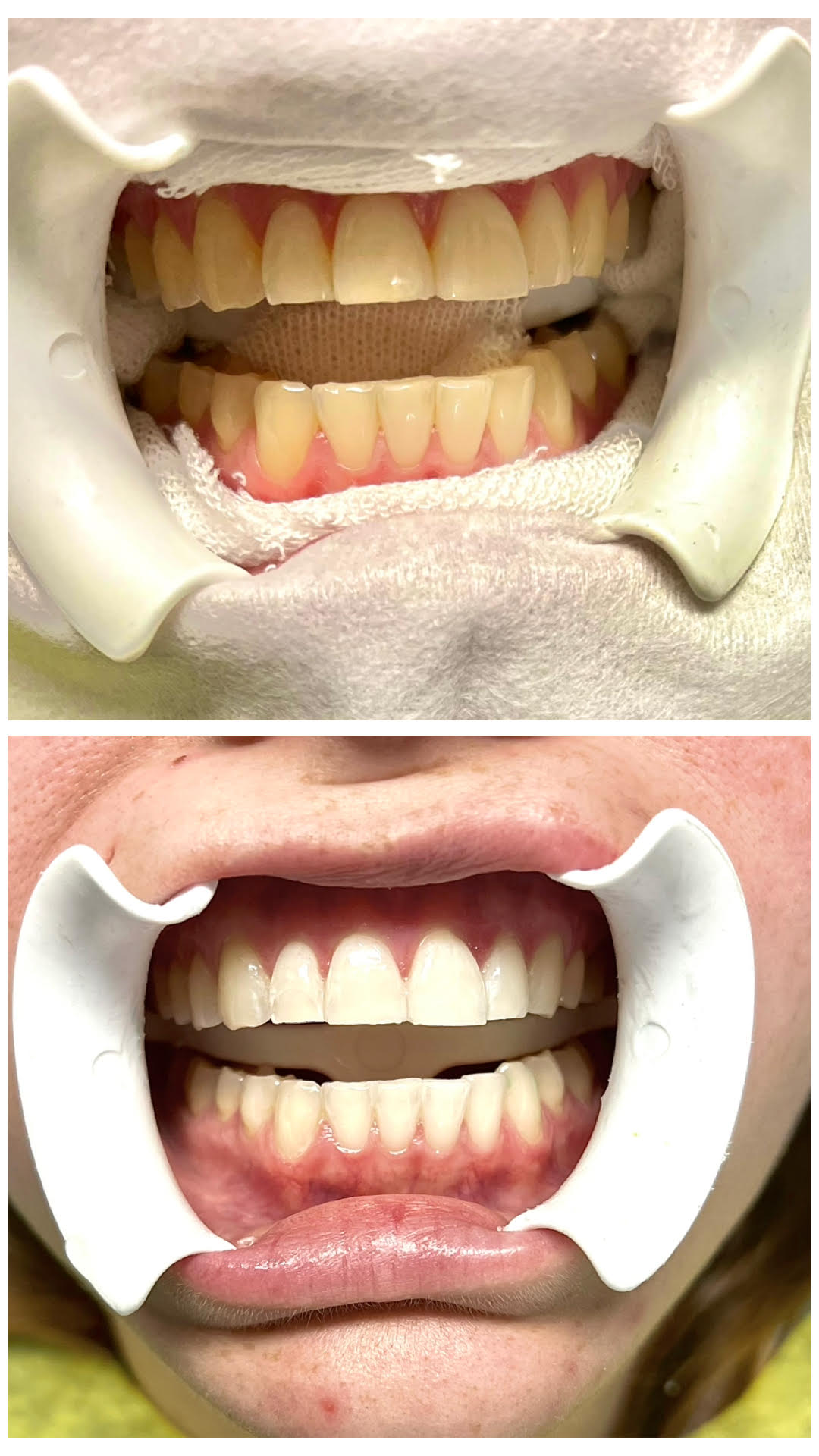 blanqueamiento-2 https://topdental.com.ar/wp-content/uploads/2025/10/blanqueamiento-2.jpg