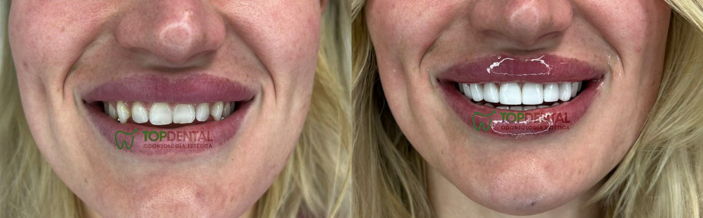 carillas de porcelana