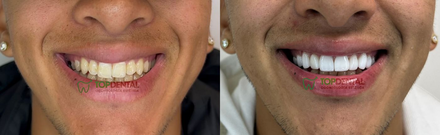 carillas de porcelana