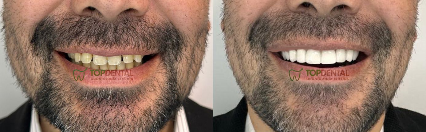 carillas de porcelana