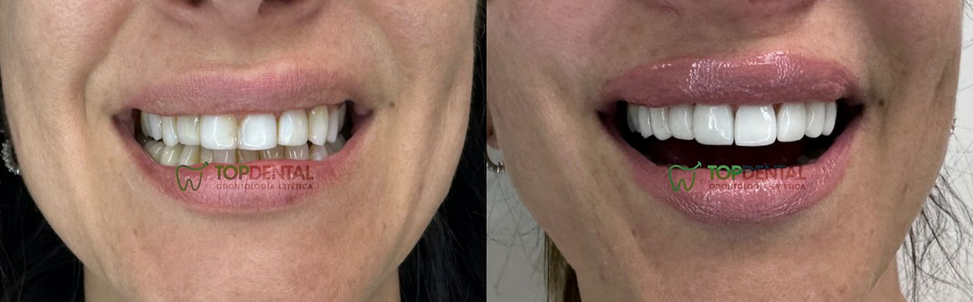 carillas de porcelana