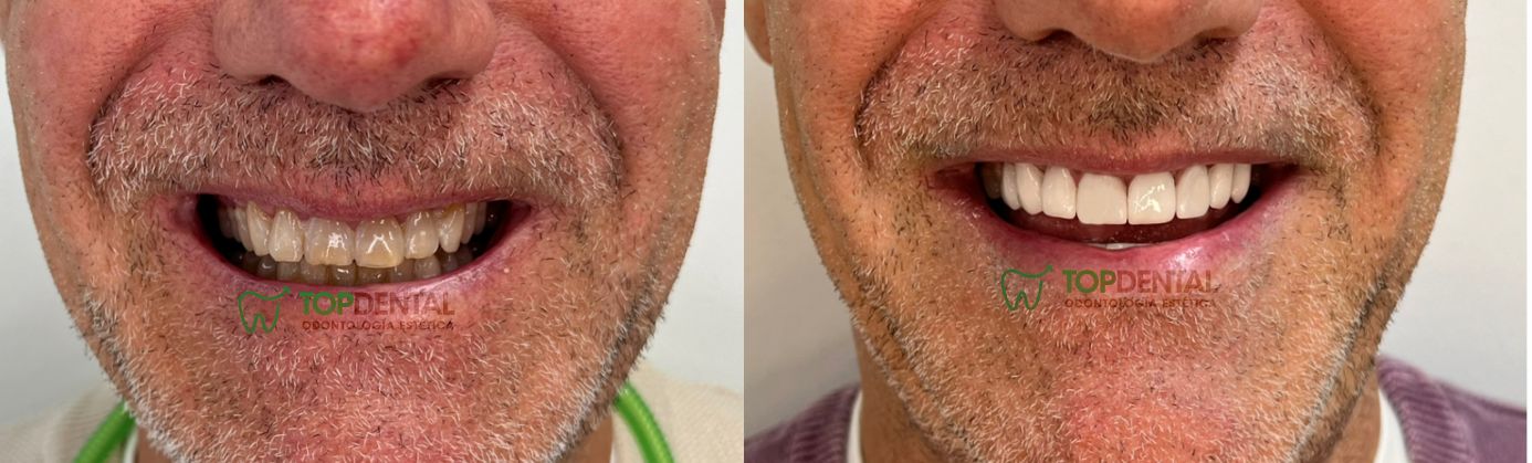 carillas de porcelana