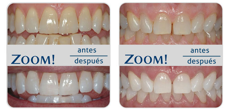 Blanqueamiento dental Philips Zoom Blanqueamiento dental Philips Zoom